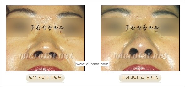 ​[두한성형외과의 No.1 경쟁력 미세(자가)지방이식] - [코높힘 미세(자가)지방이식 ②] 관련 이미지 12