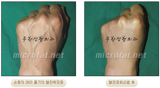 [Duhan Plastic Surgery Clinic Varicose Veins] - [Hand and Arm Venous Dilation] image 8