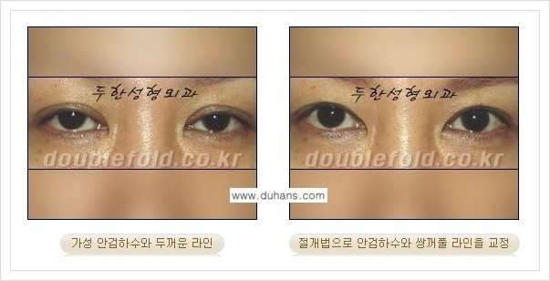 [두한성형외과 경쟁력 쌍꺼풀 재수술, 극한 눈 재수술] - [안검하수(졸리운 눈매) 재수술 안내] 관련 이미지 8