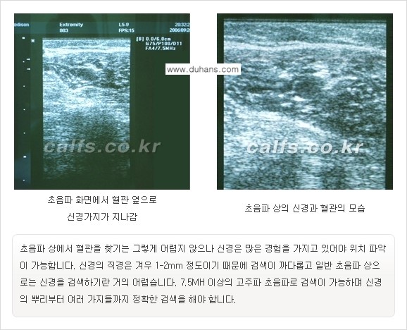 [두한성형외과 경쟁력 멀티종아리성형] - [종아리성형 방법별 전후 주의사항] 관련 이미지 10