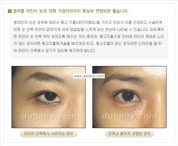[두한성형외과 경쟁력 눈성형] - [아름다운 눈매를 쌍꺼풀수술 안내 ②] 관련 이미지 3