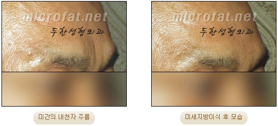 Duhan Plastic Surgery Wrinkle Improvement - Glabellar Horizontal Wrinkles, Glabellar Straight Wrinkles, Glabellar Wrinkle Surgery image 25