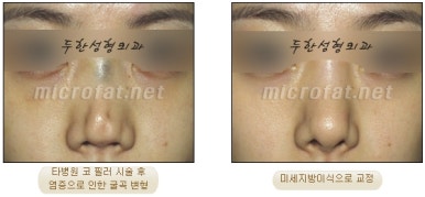 [Duhan Plastic Surgery Facial Fat Grafting] - [Fat Grafting Rhinoplasty] image 20