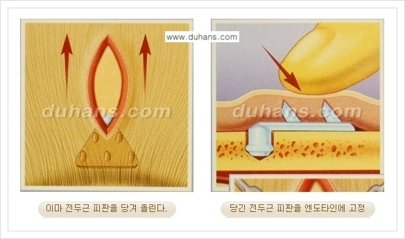 [두한성형외과 경쟁력 주름성형] - [엔도타인 리프팅 안내 ②] 관련 이미지 10