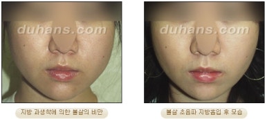 [두한성형외과 안전한 지방흡입] - [얼굴지방흡입] 관련 이미지 27