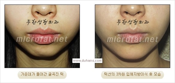 ⁠⁠[두한성형외과 경쟁력 미세지방이식] - [턱 미세지방이식 - 안면윤곽 교정 안내] 관련 이미지 25