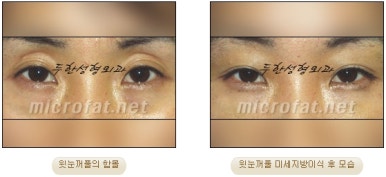 [Doohan Plastic Surgery Autologous Fat Grafting] - [Sunken Eye Fat Grafting] image 31
