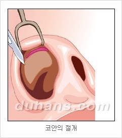 DuHan Plastic Surgery Revision Rhinoplasty - AlloDerm Nose Surgery, SureDerm Nose Surgery image 5
