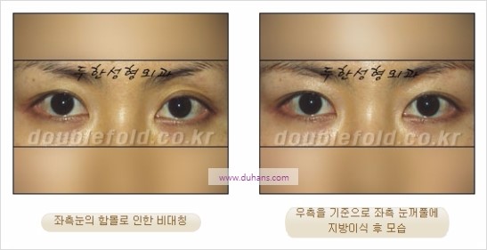 [두한성형외과 경쟁력 눈성형] - [비대칭 쌍꺼풀 라인의 여러 가지 교정 방법] 관련 이미지 21