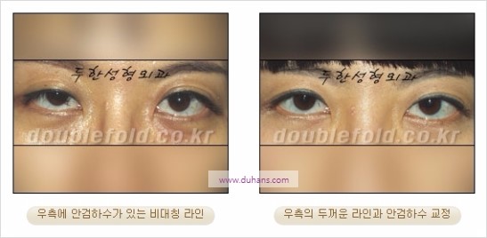 [두한성형외과 경쟁력 쌍꺼풀 재수술] - [비대칭 라인 교정(Correction of asymmetric fold line) 수술] 관련 이미지 2