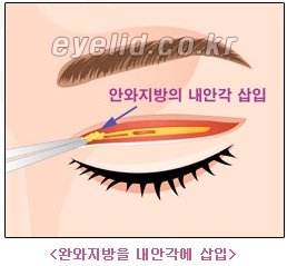 [두한성형외과 쌍꺼풀재수술] - [쌍꺼풀재수술성공요건, 쌍꺼풀재수술과정] 관련 이미지 8