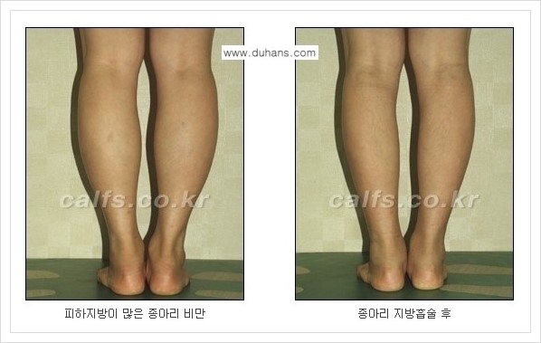 [두한성형외과 경쟁력 멀티종아리성형] - [예쁜 종아리를 만드는 종아리 지방흡입술 안내] 관련 이미지 12