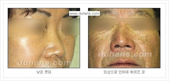 [두한성형외과 경쟁력 미세지방이식] - [자연스러운 코높임 지방이식 안내 ①] 관련 이미지 3