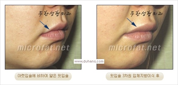 [두한성형외과 경쟁력 미세지방이식] - [입술 3차원 입체지방이식 안내 2.] 관련 이미지 1