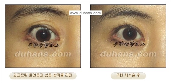 ⁠⁠⁠⁠[두한성형외과 성형 FOCUS] - [정상적인 눈매로의 복원 극한재수술 경우 ①] 관련 이미지 12