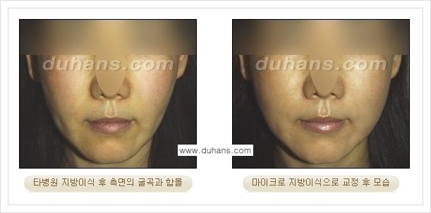 [두한성형외과 경쟁력 얼굴 미세지방이식] - [타병원에서 지방이식 후 굴곡과 과주입 교정 안내] 관련 이미지 1