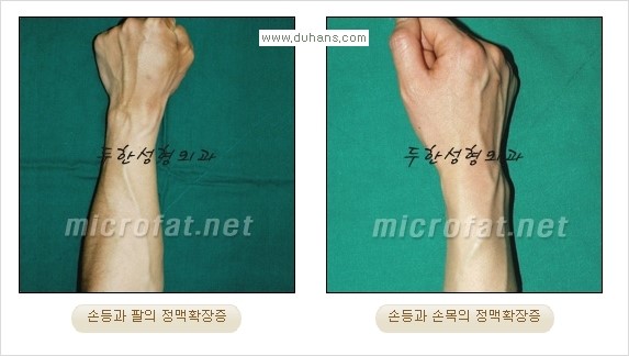 [두한성형외과 경쟁력 정맥류 치료] - [손, 손등, 손목혈관확장증, 팔혈관확장증에 질문과 답변] 관련 이미지 3