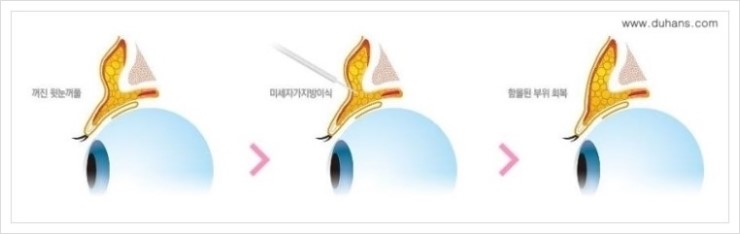[두한성형외과 경쟁력 눈밑성형] - [다크써클 + 눈위 지방이식 콤비 프로그램] 관련 이미지 4