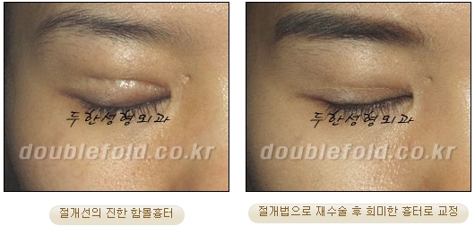 [Duhan Plastic Surgery Eye Surgery] - [Double Eyelid Scar, Double Eyelid Scar Tissue, Revision Surgery for Pigeon Eyes and Ptosis Correction] image 16
