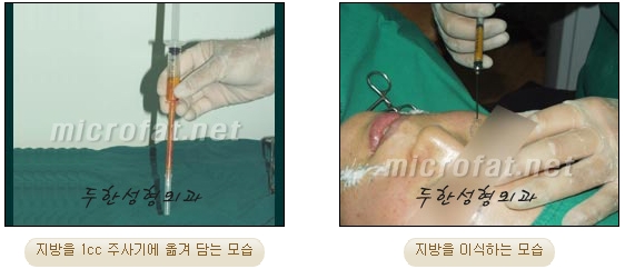 [Duhan Plastic Surgery Face Autologous Fat Grafting] - [Noble Surgery and Indian Band Fat Grafting] image 15