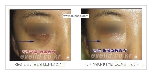 [두한성형외과 경쟁력 눈밑성형] - [눈밑 미세지방이식으로 다크써클 치료] 관련 이미지 4