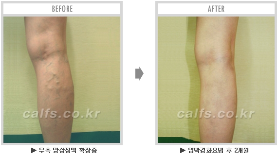 [종아리성형 두한성형외과] - [종아리수술에 대한 자주하는 질문과 답변 모음] 관련 이미지 27