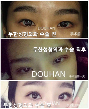 [Duhan Plastic Surgery Eyelid Surgery] - [Epicanthoplasty, Medial Canthoplasty] image 12