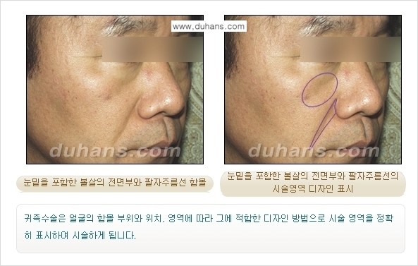 ⁠[두한성형외과 경쟁력 미세지방이식] - [귀족수술 - 입체미세지방이식 ①] 관련 이미지 7