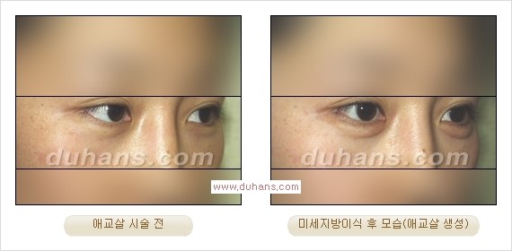 [두한성형외과 경쟁력 눈밑성형] - [눈밑애교살 시술을 위한 미세지방이식] 관련 이미지 18