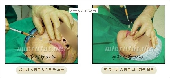 ​​​[두한성형외과 경쟁력 지방이식] - [지방이식을 이용한 입술성형 안내] 관련 이미지 7