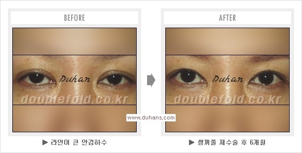 [두한성형외과 경쟁력 쌍꺼풀 재수술, 극한 눈재수술] - [쌍꺼풀 재수술을 위한 검사와 테스트] 관련 이미지 8