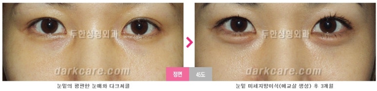 [두한성형외과 다크서클] - [다크서클 전후사진 검증] 관련 이미지 65