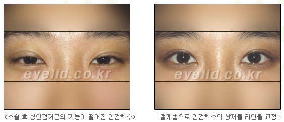 [Duhan Plastic Surgery Secondary Double Eyelid Surgery] - [Sleepy Eye Appearance, Asymmetrical Eye Appearance, Ptosis] image 10
