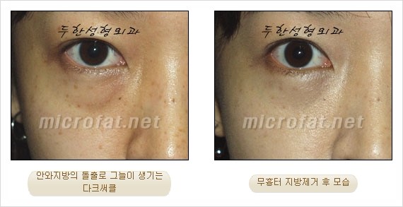[두한성형외과 쌍커풀수술] - [눈성형 방법에 대한 자주하는 질문과 답변] 관련 이미지 166