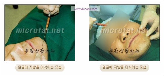 [두한성형외과 경쟁력 윤곽성형] - [볼, 볼살 지방이식] 관련 이미지 11
