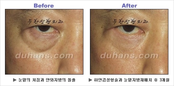 [두한성형외과 경쟁력 동안성형 리더] - ​[미간주름, 이마주름, 안검성형, 이마거상술, 눈썹거상술] 관련 이미지 69