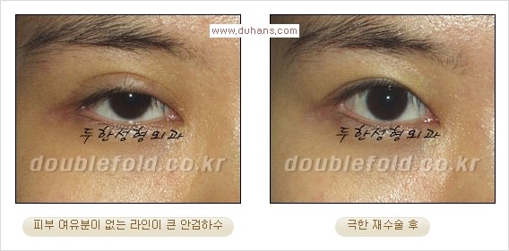 [두한성형외과 경쟁력 쌍꺼풀 재수술] - [피부 여유분이 부족해서 토안증이 발생한 경우 극한 재수술] 관련 이미지 6