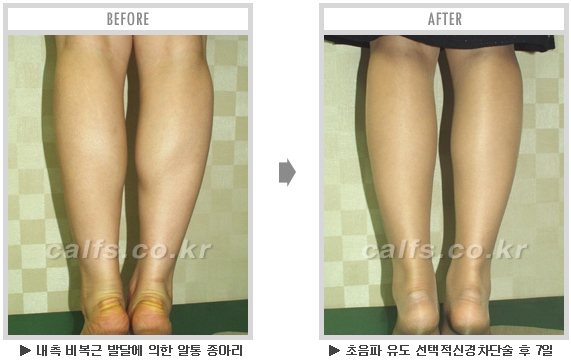[종아리성형 두한성형외과] - [종아리수술에 대한 자주하는 질문과 답변 모음] 관련 이미지 56