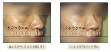 [두한성형외과 얼굴자가지방이식] - [지방이식 과정] 관련 이미지 47
