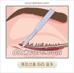 [두한성형외과 경쟁력 안검성형] - [젊어 보이면서 개선된 인상을 주기 위한 성형] 관련 이미지 4