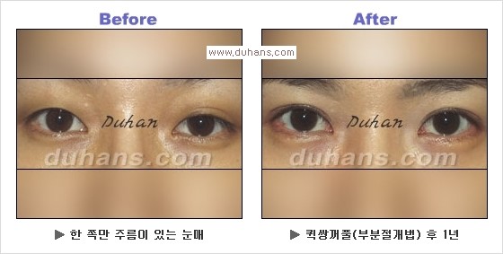 [두한성형외과 경쟁력 눈성형] - [Dr. 컬럼  "어떤 쌍꺼풀이 아름다운 쌍꺼풀인가?!] 관련 이미지 17