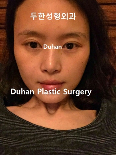 [두한성형외과 쌍커풀수술] - [쌍꺼풀지방이식] 관련 이미지 67