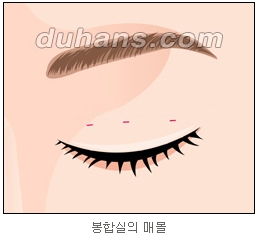 [두한성형외과 쌍커풀수술] - [매력적인 쌍커풀] 관련 이미지 17