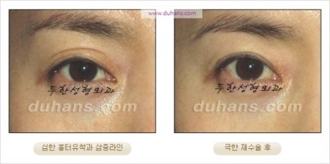 ​[두한성형외과 눈재수술] - [앞트임복원, 뒤트임복원, 쌍꺼풀복원] 관련 이미지 20