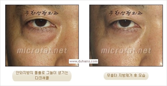 [두한성형외과 경쟁력 눈밑성형] - [과도한 눈밑지방제거의 부작용 후 눈밑지방재배치] 관련 이미지 20
