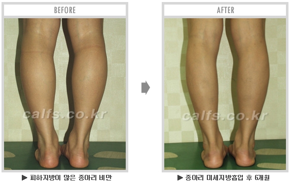 [종아리성형 두한성형외과] - [종아리수술에 대한 자주하는 질문과 답변 모음] 관련 이미지 74