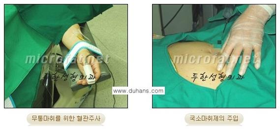 [두한성형외과 경쟁력 바디성형] - [아랫배, 윗배, 옆구리살, 허리살, 팔뚝살 지방흡입] 관련 이미지 6