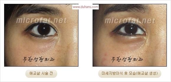 ​﻿[두한성형외과 경쟁력 지방이식] - [눈밑 애교살 시술을 위한 미세지방이식] 관련 이미지 13