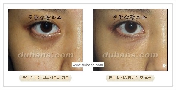 [두한성형외과 경쟁력 눈밑성형] - [꺼진 눈밑, 눈밑 함몰 주름선 눈밑 미세지방이식 안내] 관련 이미지 7