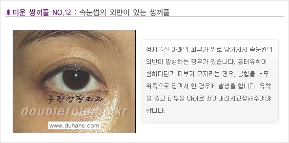 [두한성형외과 경쟁력 눈성형] - [미운 쌍꺼풀이란?] 관련 이미지 13
